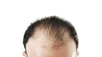 Erkek Tipi Saç Dökülmesi (androgenetik alopesi)